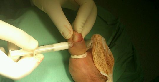 Els tractaments percutanis amb hidroxiapatita nanocristalina redueixen l'agressivitat quirúrgica