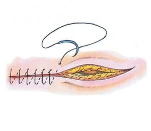 La-cicatrizacion-depende-del-pH-de-la-herida